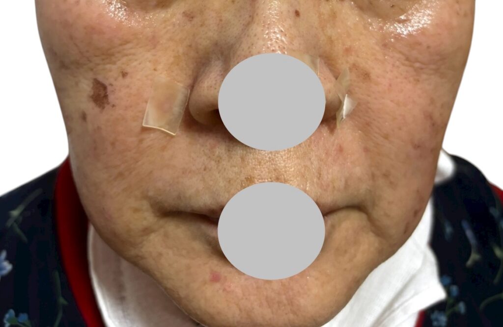 シミ・イボ・ホクロ取り放題施術から1週間後の顔写真（赤みが減り、かさぶたが取れて肌が明るくなった状態）