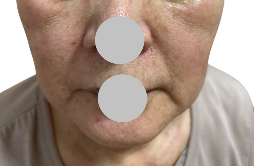 シミ・イボ・ホクロ取り放題施術から１ヶ月後の顔写真（かさぶたが落ち着き、全体的に明るくなった状態）