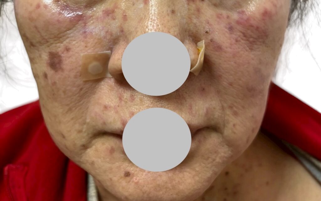 シミ・イボ・ホクロ取り放題施術直後の顔写真（赤みと黒い点が目立つ状態、ホクロ部分にテープを貼っている）
