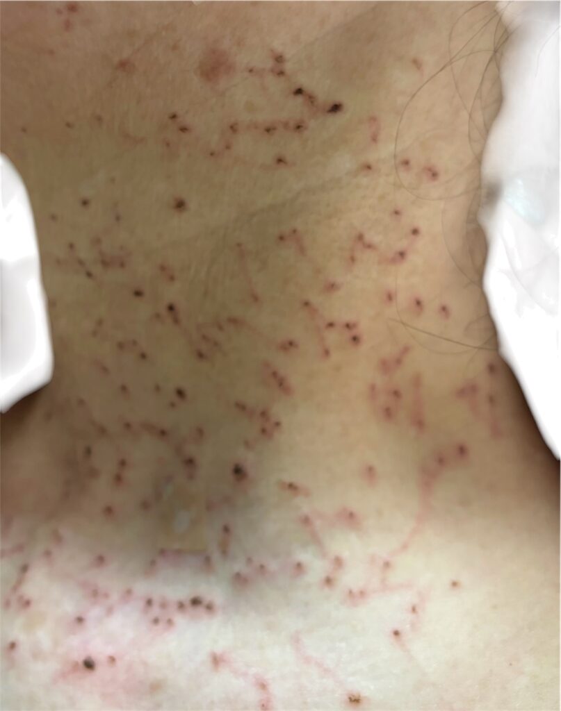 シミ・イボ・ホクロ取り放題施術直後の首写真（赤みと黒い点状の跡が強く出ている状態・閲覧注意！）