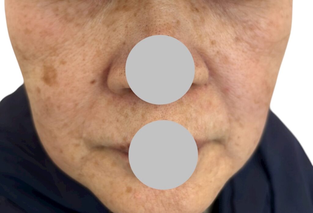 シミやホクロが全体にある施術前の顔写真（69歳女性）