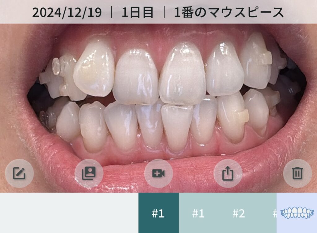 インビザライン矯正開始前