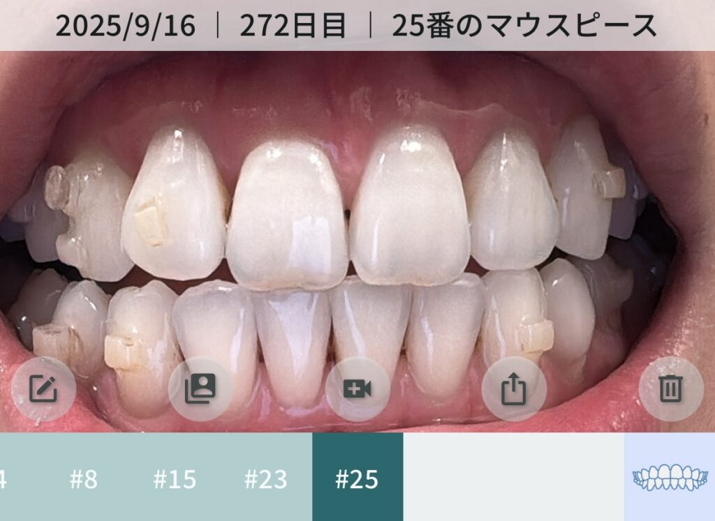 インビザライン矯正9ヶ月後