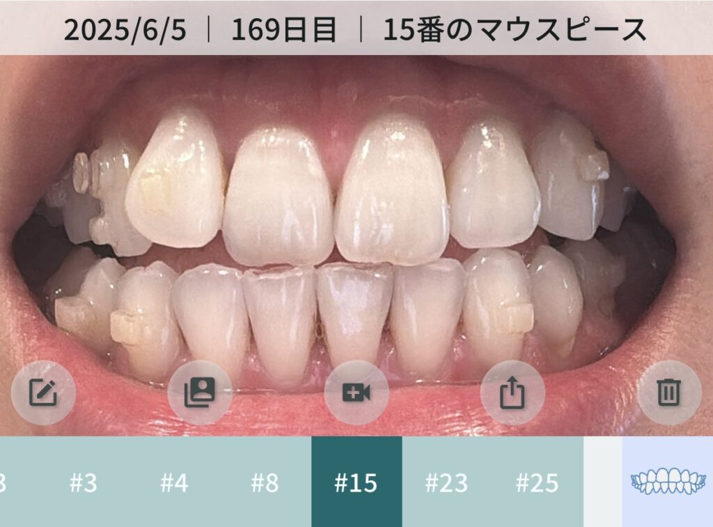 インビザライン矯正６ヶ月後